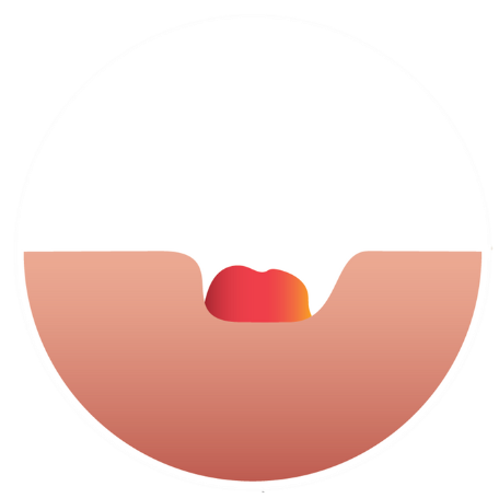 Soft Convex Flange